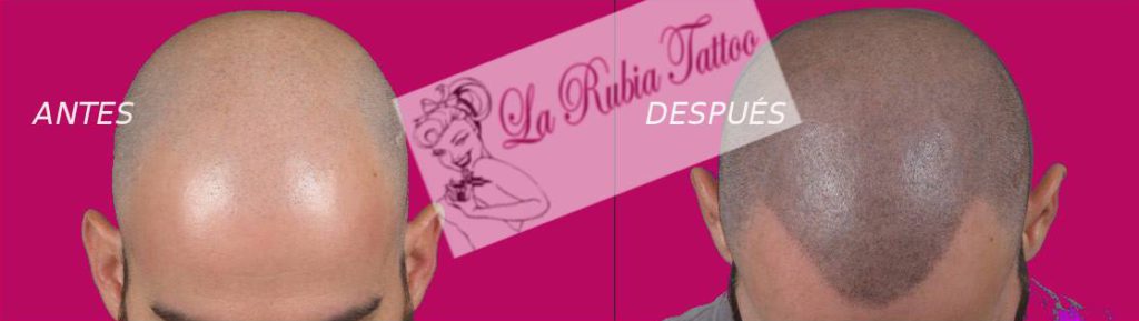Micropigmentación de alopecia