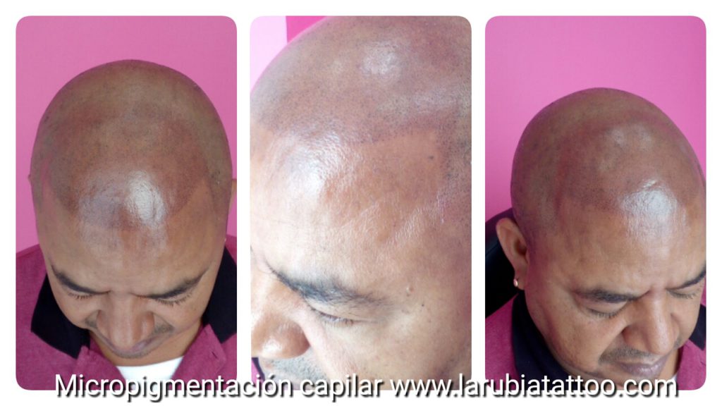 Micropigmentación de alopecia