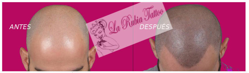 reconstrucción de alopecia