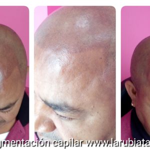 Micropigmentación capilar de alopecia