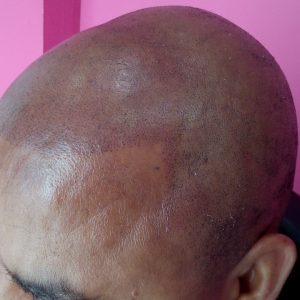 Micropigmentación capilar de alopecia